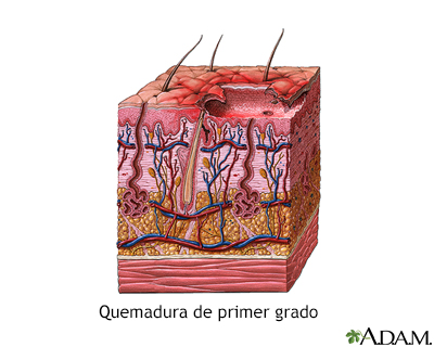 Quemadura de primer grado - Miniatura de ilustración
              