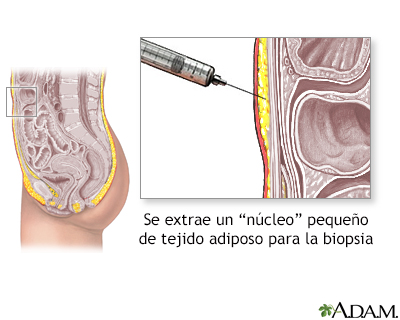 Biopsia de tejido graso - Miniatura de ilustración
              