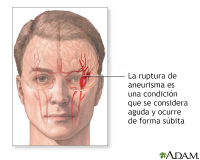 Ruptura de aneurisma intracraneal - Miniatura de ilustración
              