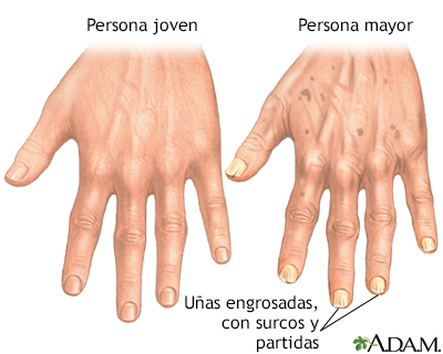 Cambios en las uñas por el envejecimiento - Miniatura de ilustración
              