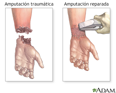 Reparación de amputación