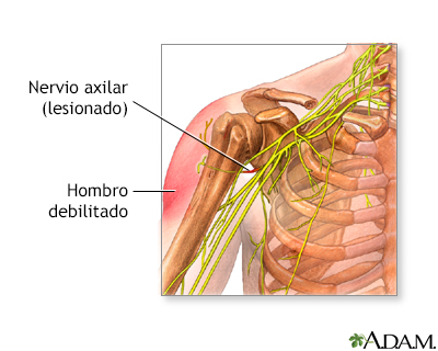 Daño al nervio axilar