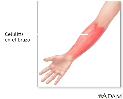 Celulitis en el brazo - Miniatura de ilustración
              