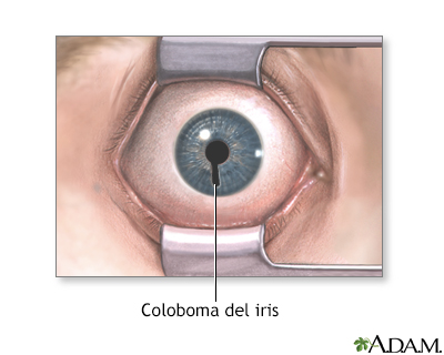 Coloboma del iris - Miniatura de ilustración
              