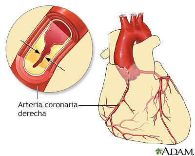 Materialismo Anticuado compromiso Spanish HIE Multimedia - Enfermedad de las arterias coronarias