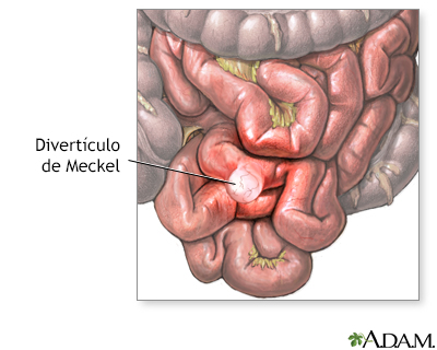 Divertículo de Meckel - Miniatura de ilustración
              