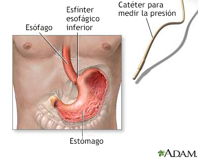 Manometría esofágica - Miniatura de ilustración
              
