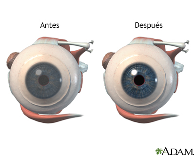Antes y después de cirugía corneal - Miniatura de ilustración
              
