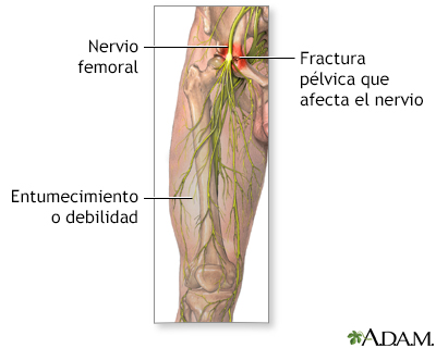 Daño al nervio femoral - Miniatura de ilustración
              
