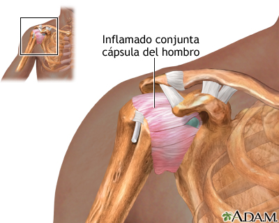 Inflamación de la articulación del hombro - Miniatura de ilustración
              