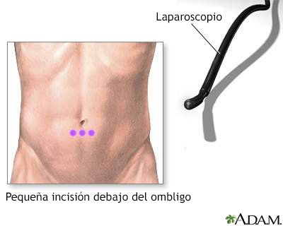 Incisión para realizar laparoscopia abdominal - Miniatura de ilustración
              