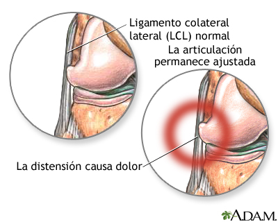 Dolor del ligamento colateral externo