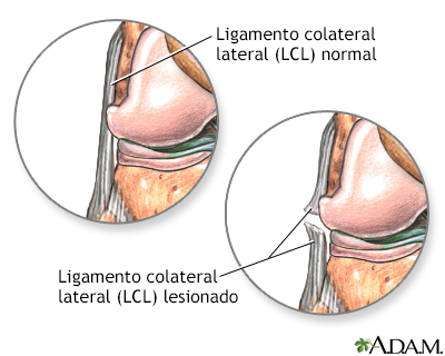 Ligamento colateral lateral desgarrado