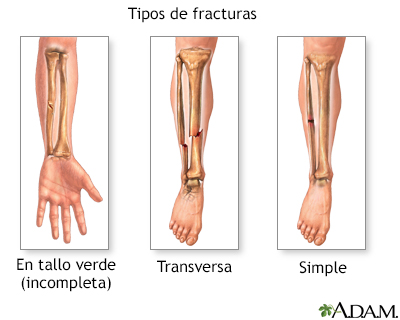 Tipos de fractura (2) - Miniatura de ilustración
              