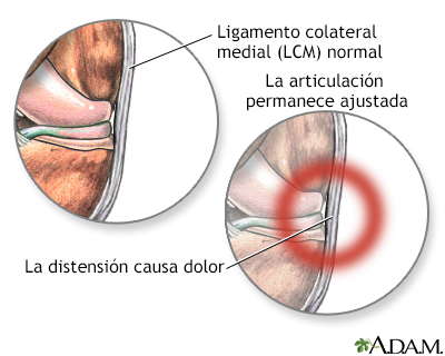 Dolor del ligamento medial colateral - Miniatura de ilustración
              