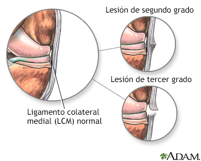 Lesión del ligamento medial colateral - Miniatura de ilustración
              
