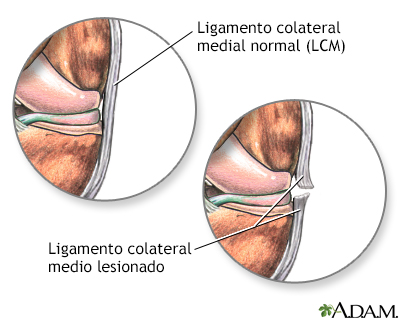Ligamento medial colateral desgarrado - Miniatura de ilustración
              