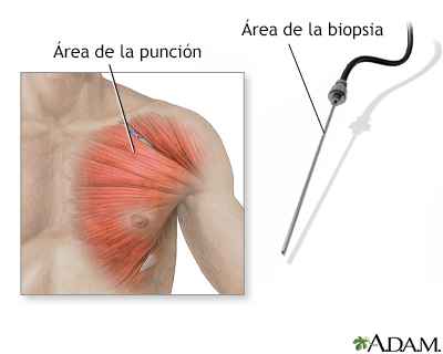 Biopsia muscular - Miniatura de ilustración
              
