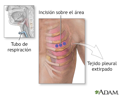 Incisión para biopsia de tejido pleural - Miniatura de ilustración
              