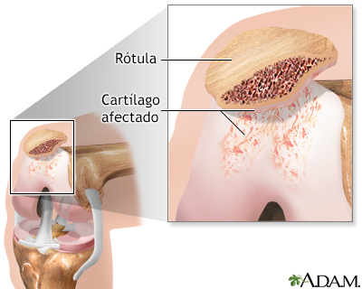 Condromalacia patelar - Miniatura de ilustración
              