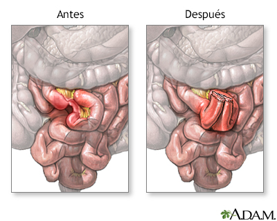 Antes y después de anastomosis del intestino delgado - Miniatura de ilustración
              