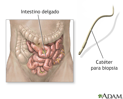 Biopsia del intestino delgado - Miniatura de ilustración
              