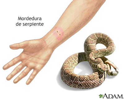 Mordedura de serpiente - Miniatura de ilustración
              