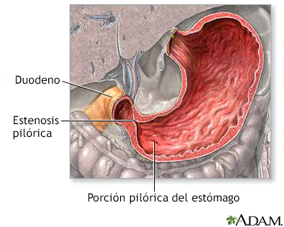 Estenosis pilórica - Miniatura de ilustración
              