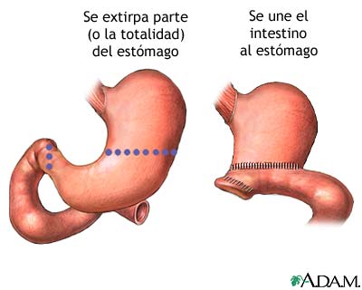 Gastrectomía - Miniatura de ilustración
              