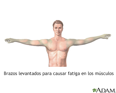 Fatiga muscular - Miniatura de ilustración
              