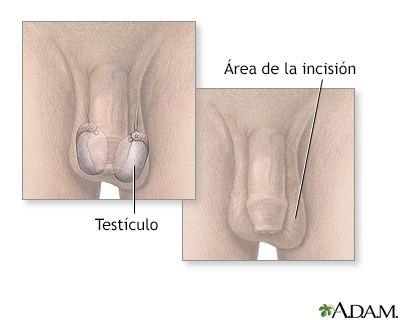 Biopsia testicular - Miniatura de ilustración
              