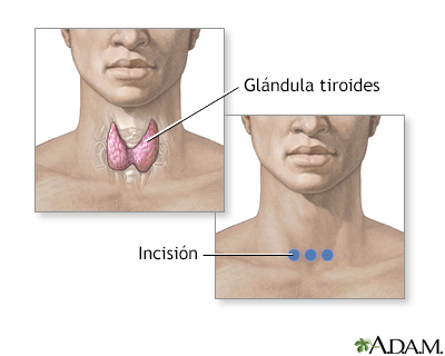 Incisión para realizar cirugía de la glándula tiroides