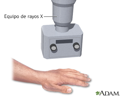Rayos X de la mano - Miniatura de ilustración
              