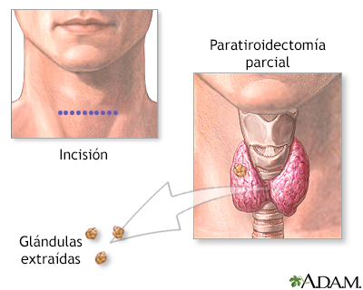 Paratiroidectomía - Miniatura de ilustración
              