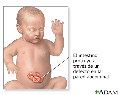 Hernia abdominal infantil (gastrosquisis) - Miniatura de ilustración
              