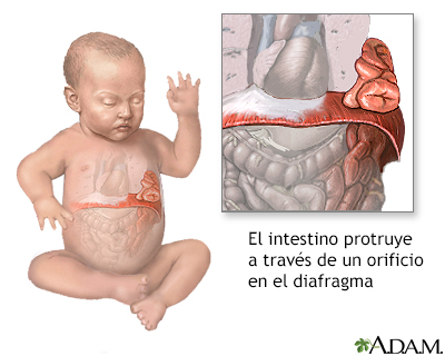 Hernia diafragmática infantil - Miniatura de ilustración              