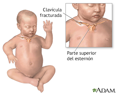 Clavícula fracturada en un recién nacido