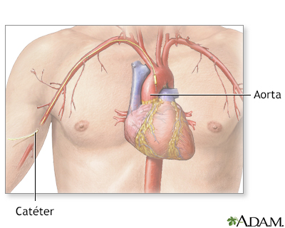 Arteriograma cardíaco - Miniatura de ilustración
              