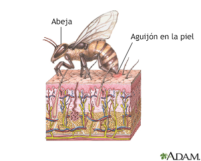 Picadura de abeja - Miniatura de ilustración
              