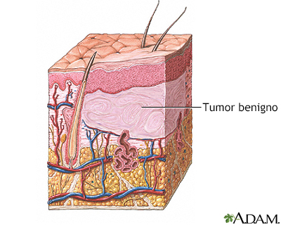 Tumor benigno de la piel - Miniatura de ilustración
              