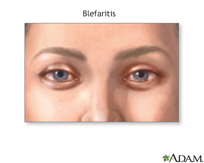 Blefaritis - Miniatura de ilustración
              