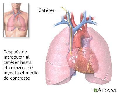 Cateterización cardíaca