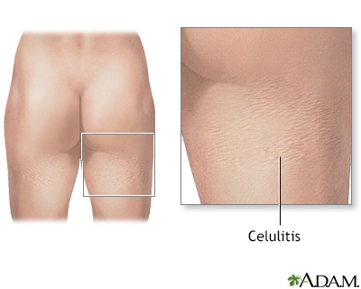 Celulitis - Miniatura de ilustración
              