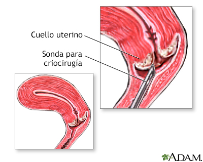 Criocirugía cervical - Miniatura de ilustración
              