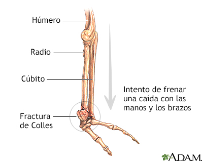 Fractura de Colles - Miniatura de ilustración
              