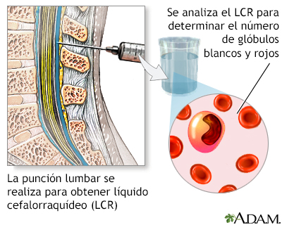 Conteo de células del LCR