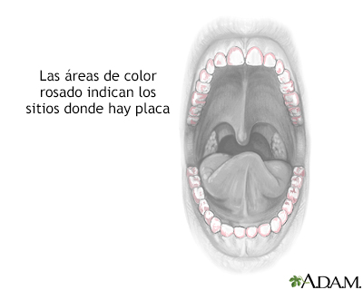 Coloración de la placa dental