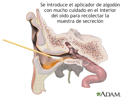 Cultivo del drenaje del oído - Miniatura de ilustración
              