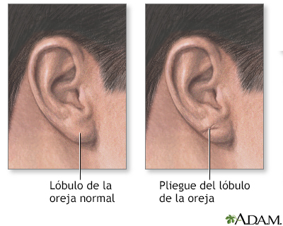 Pliegue del lóbulo de la oreja - Miniatura de ilustración
              