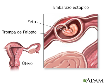 Embarazo ectópico - Miniatura de ilustración
              